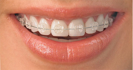 braces on teeth - Garn & Mason Orthodontics in Phoenix, AZ - Queen Creek, Mesa, Chandler, Gilbert