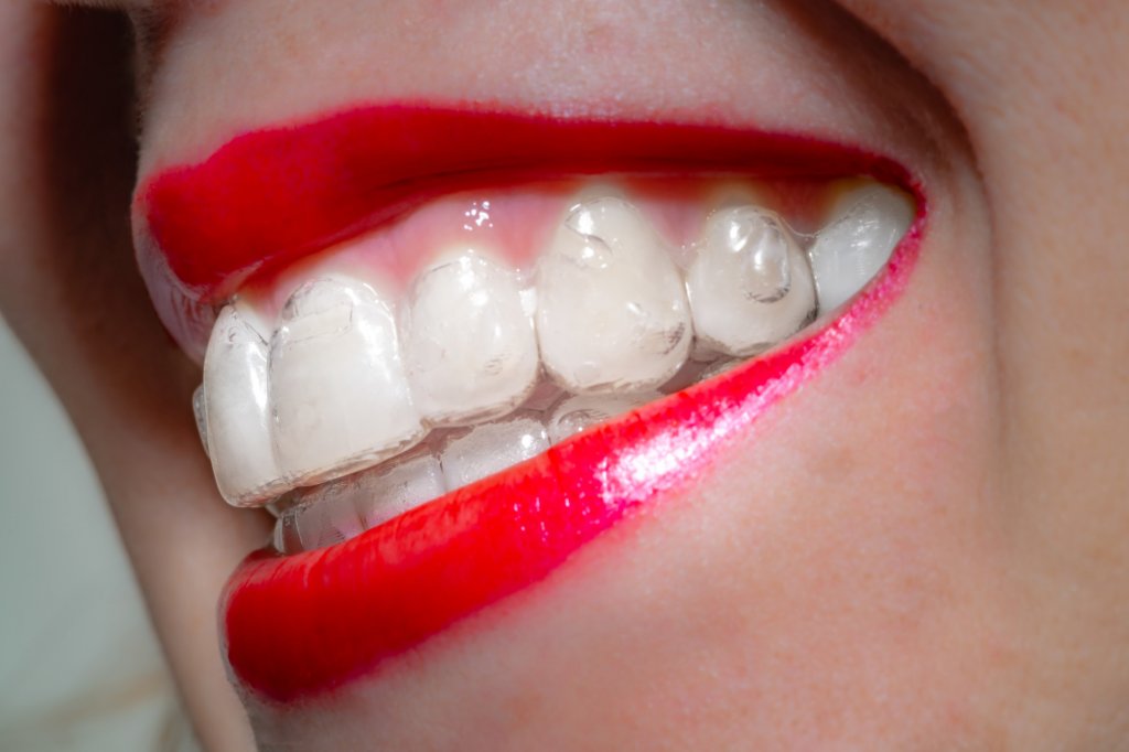 Invisalign treatment in Arizona - Garn & Mason Orthodontics in Phoenix, AZ - Queen Creek, Mesa, Chandler, Gilbert
