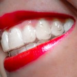Invisalign treatment in Arizona - Garn & Mason Orthodontics in Phoenix, AZ - Queen Creek, Mesa, Chandler, Gilbert