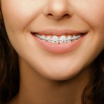 Closeup of orthodontic treatment for female - Garn & Mason Orthodontics in Phoenix, AZ - Queen Creek, Mesa, Chandler, Gilbert