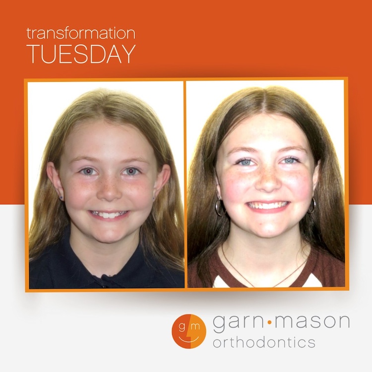 Teen transformation at Garn & Mason Orthodontics